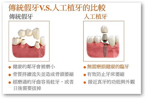 缺牙梗圖|缺牙一定要植牙？假牙該如何挑選？牙醫師一次告訴你｜元氣